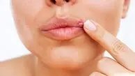 آیا می‌توان برای همیشه از شر تبخال خلاص شد؟
