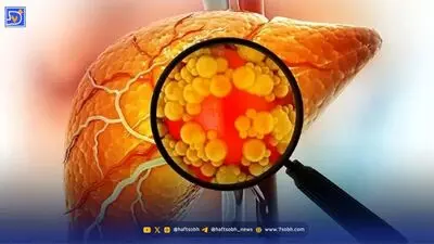 کبد چرب چیست؟ علائم، دلایل و راه‌های پیشگیری که باید بدانید
