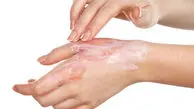 علت سوزش بی دلیل پوست پا و دست ها چیست؟
