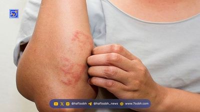 ۳ خوراکی که ریزش مو را تشدید می‌کنند؛ از نوشابه تا الکل
