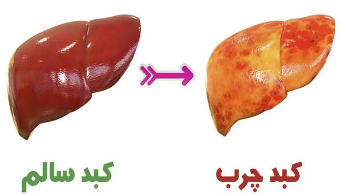 پنج علامت مهم ابتلا به کبد چرب