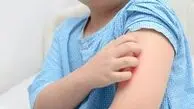 بهترین دارو برای خارش بدن کودکان