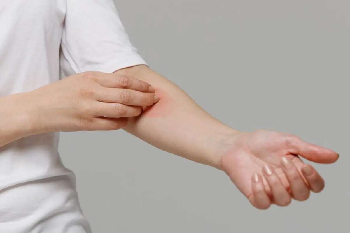 بهترین دارو برای خارش بدن در طب سنتی