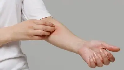بهترین دارو برای خارش بدن گیاهی