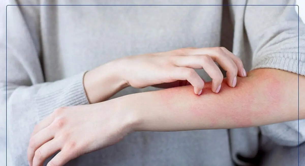 بهترین دارو گیاهی برای خارش بدن