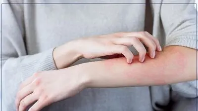 بهترین دارو گیاهی برای خارش بدن