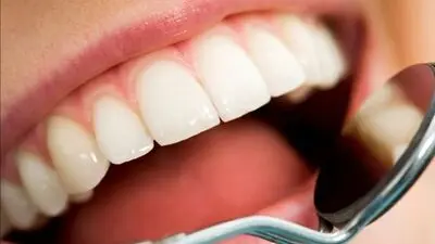 آیا کشیدن دندان عقل همیشه ضروری است؟ همه چیز درباره دندان‌های عقل