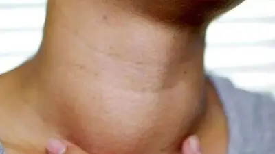 اگر این علائم را دارید به پزشک مراجعه کنید/ تیروئید شما کم‌کار است