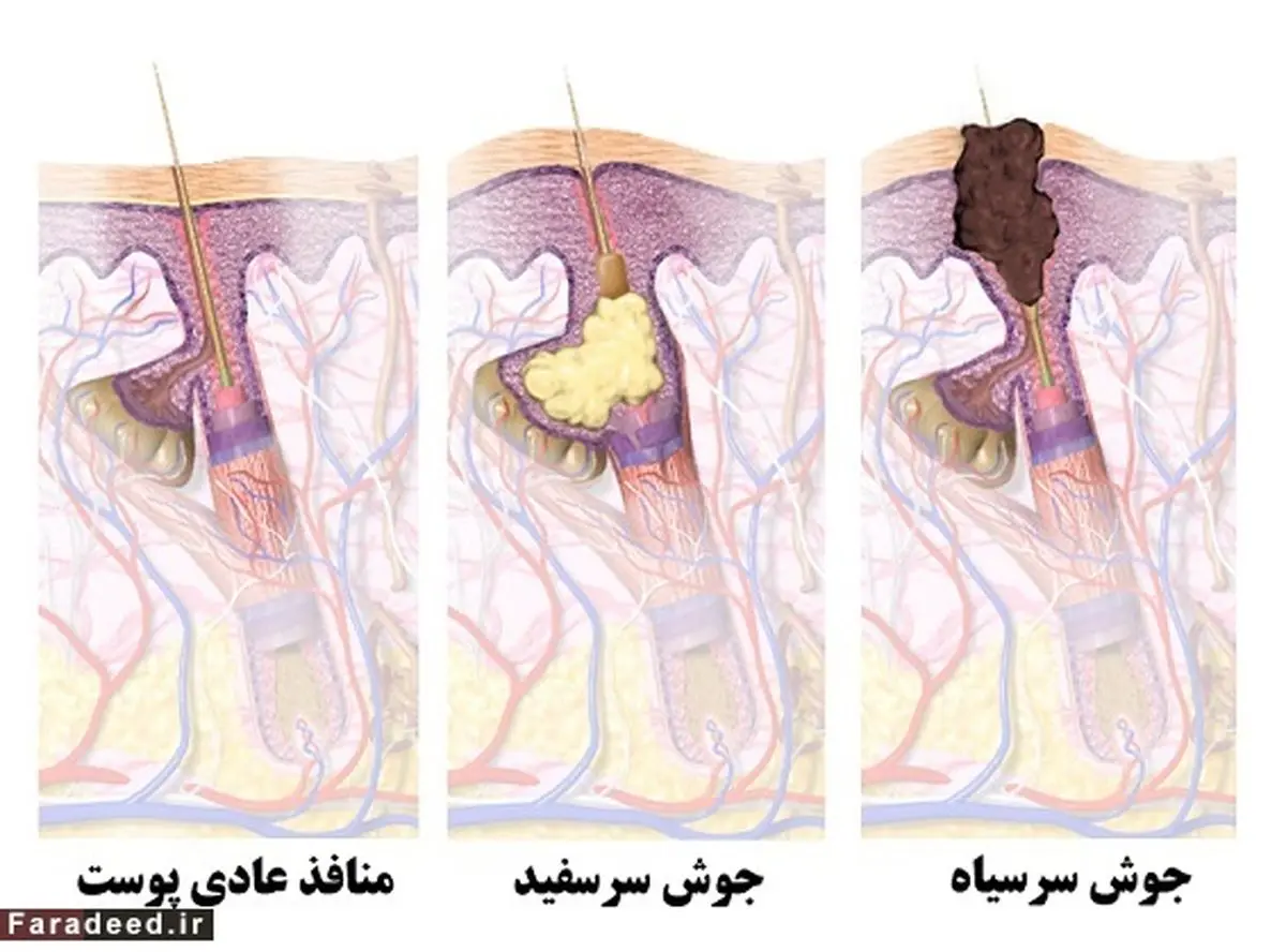 روش درمان قطعی جوش سرسیاه