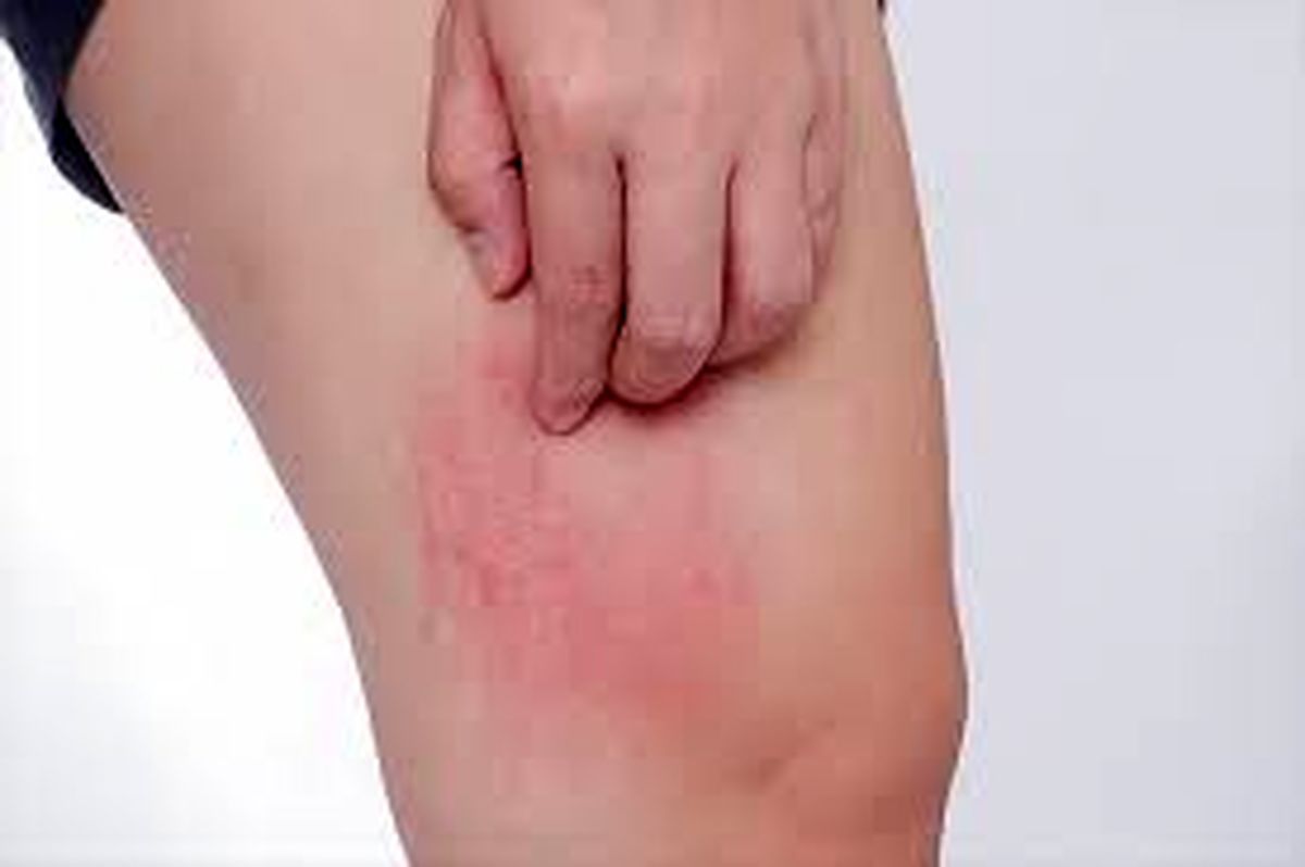 کهیر پوستی چیست؟