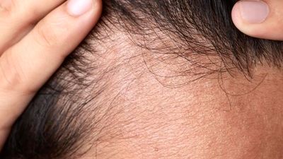 بهترین مکمل ها برای ضخیم شدن تار مو