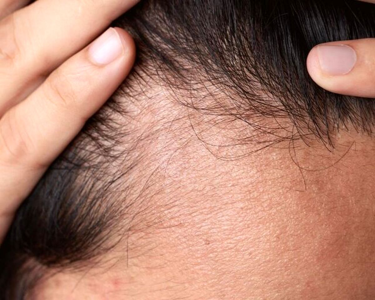 درمانی جدید برای ریزش مو