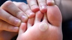 میخچه چگونه درمان می‌شود؟