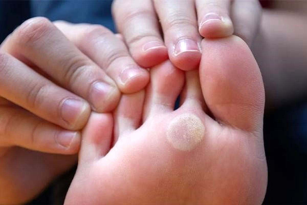 میخچه چگونه درمان می‌شود؟