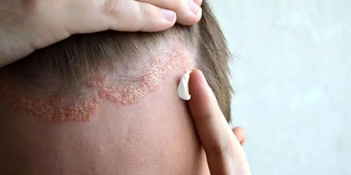 درمان سریع اگزما پوست سر با بهترین دکتر پوست ومو