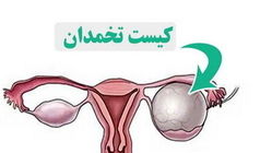 
کیست تخمدان؛ مشکل شایع اما اغلب بی‌خطر در زنان
