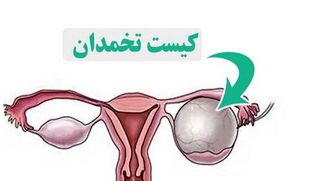 کیست تخمدان؛ مشکل شایع اما اغلب بیخطر در زنان