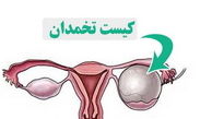 
کیست تخمدان؛ مشکل شایع اما اغلب بی‌خطر در زنان
