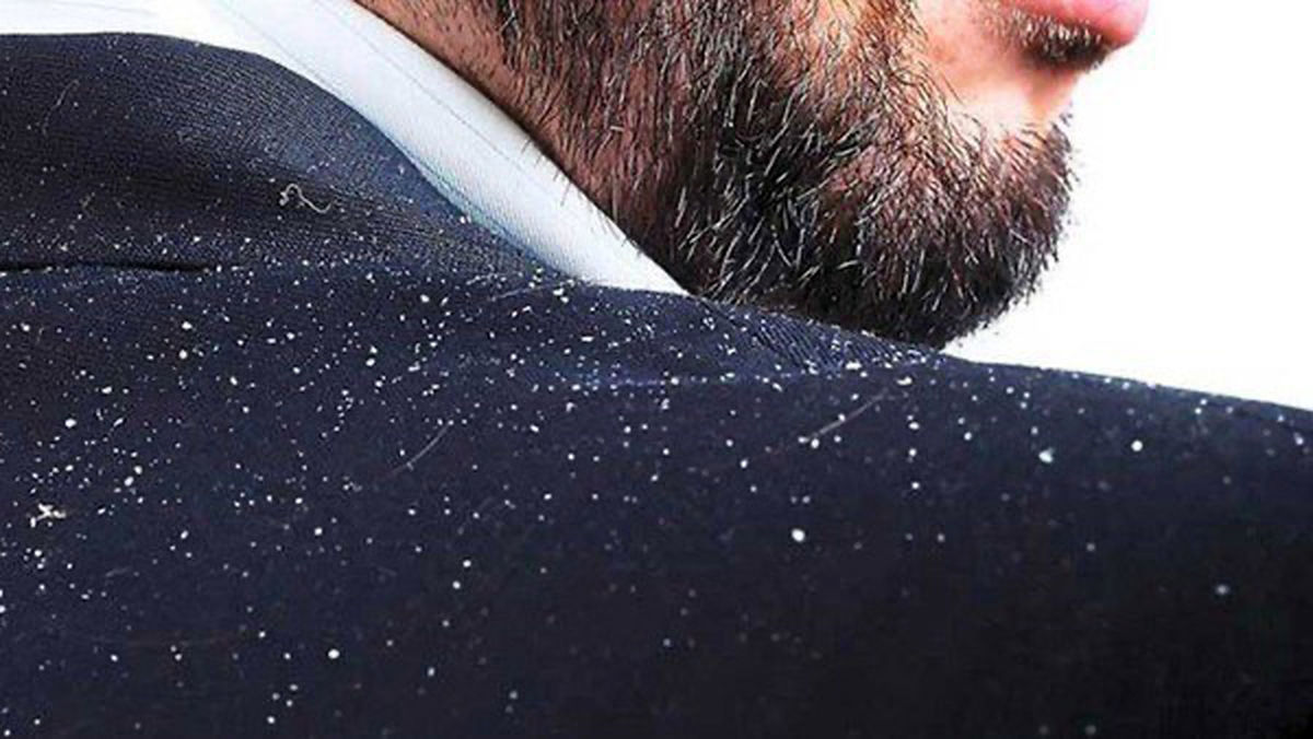 شوره کف سر به چه دلایلی به وجود می آید؟