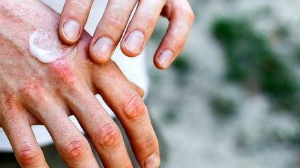 علت پوست پوست شدن اطراف ناخن و روش های درمان