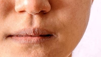 ترند امسال عامل طاسی دائمی زنان است