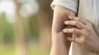 بدون اینکه ضربه بخورید کبود می‌شوید؟ علت‌های پنهان کبودی را بشناسید