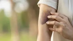 بدون اینکه ضربه بخورید کبود می‌شوید؟ علت‌های پنهان کبودی را بشناسید